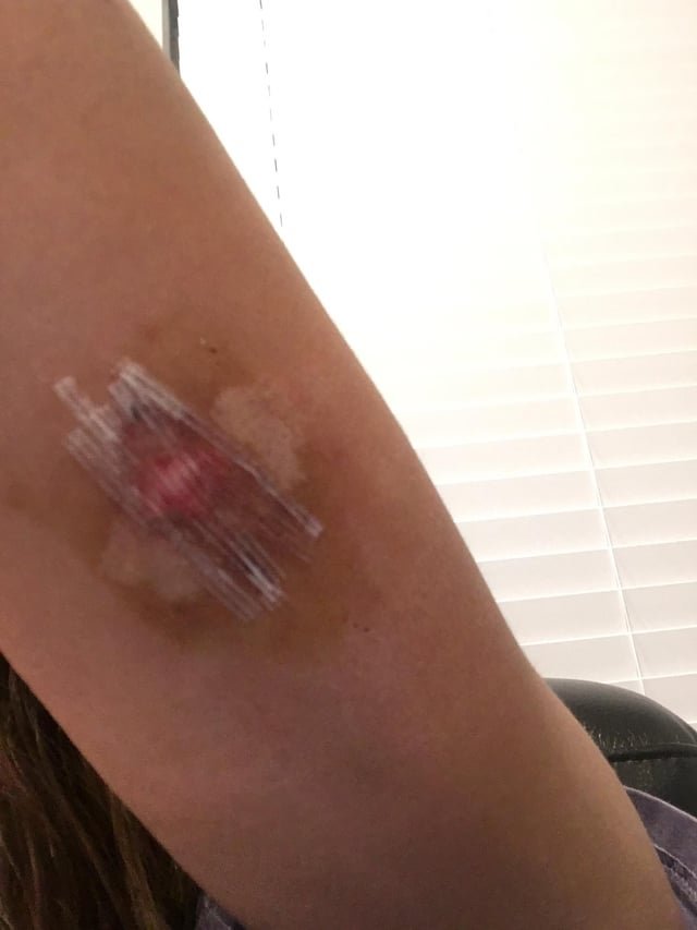How Long After Nexplanon Insertion Can I Shower: Explained