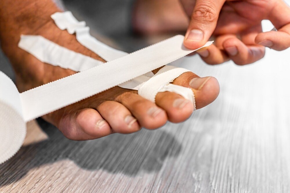 How Long Second Toe Capsulitis Heal: Proven Recovery Timeline