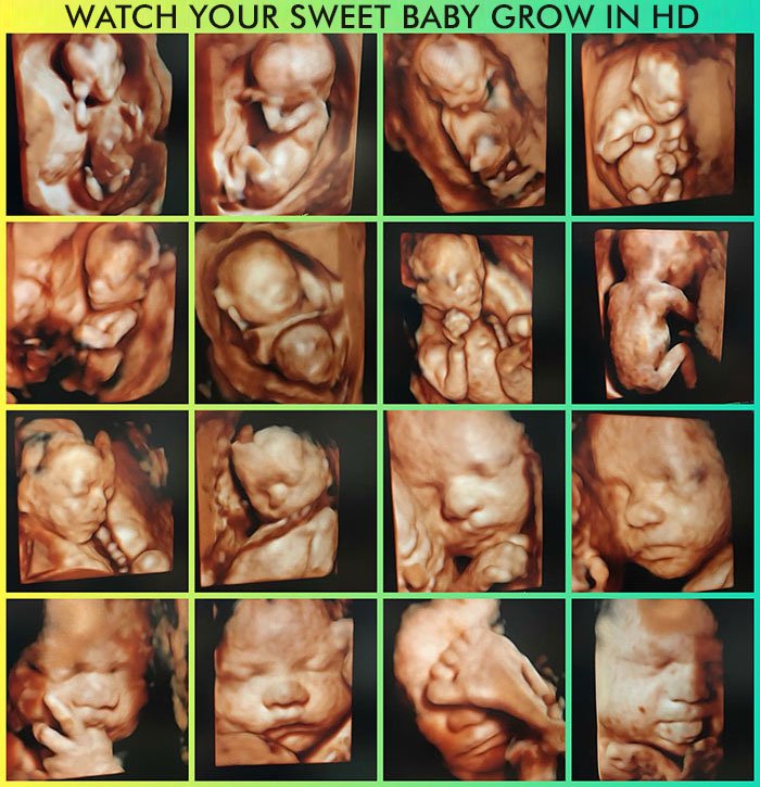 Exploring The Cost Of 3D Ultrasound: How Much Is 3D Ultrasound?